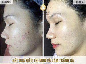 Acne Treatment And Skin Brightening For You The Last Nature