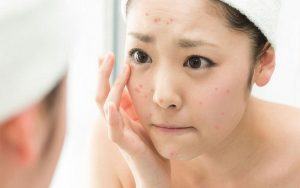 Principles of acne treatment