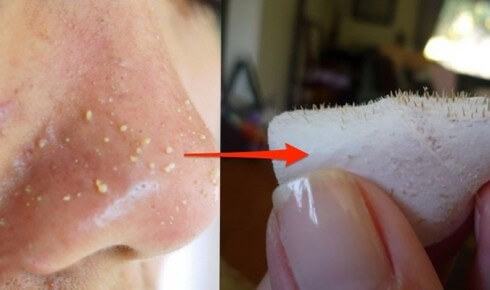 The Location Of Acne On Your Face Says What's Recognized