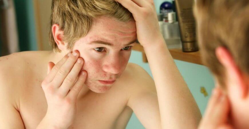 Causes of Men's Acne Never Ends List