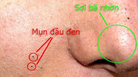 Mụn nhỏ dưới cằm và mũi là bệnh gì?