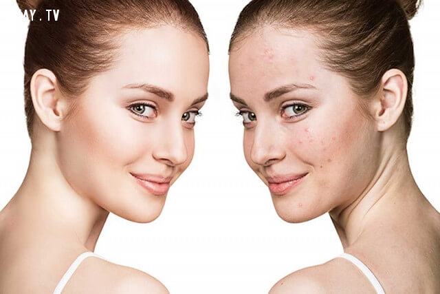 Top 7 Harmful Mistakes When Treating Acne At Home Expertly