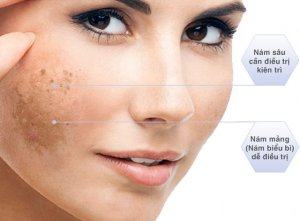Remove Melasma Effectively With Each Level of Understanding