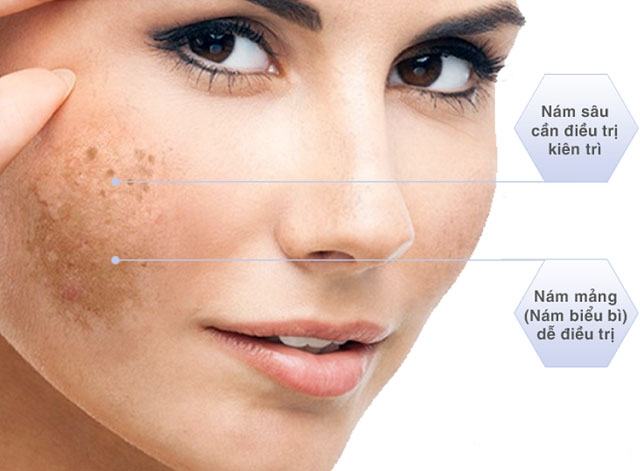 Remove Melasma Effectively By Levels Articles