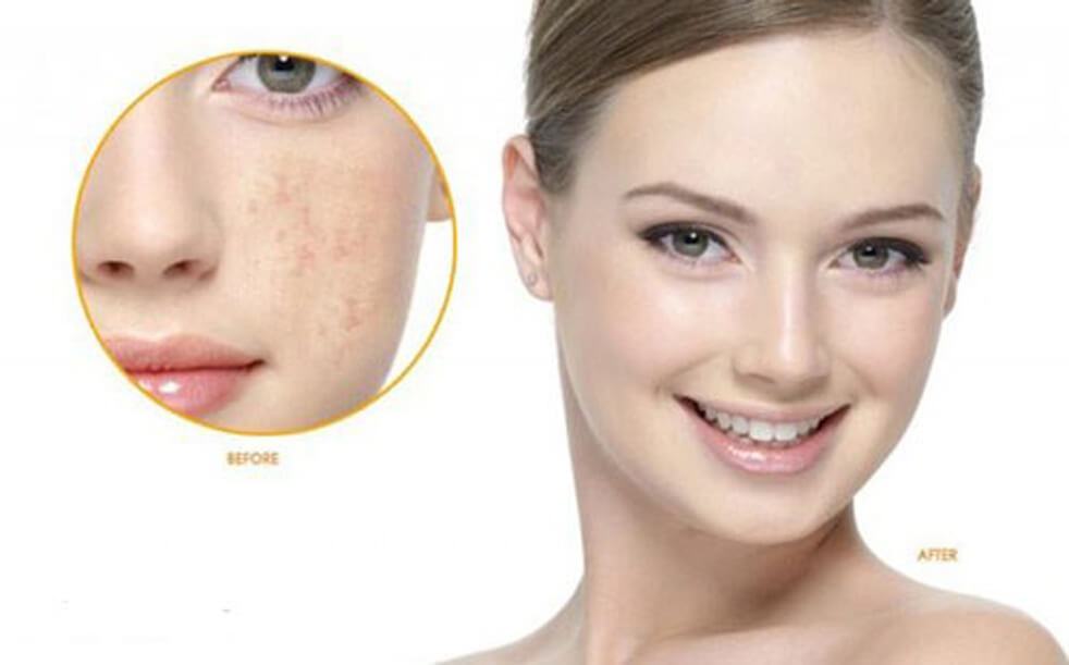 How to Treat Melasma with Hormonal Effective Results