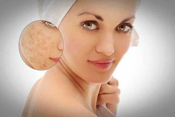 Wrong skin care causes pitted scar treatment failure