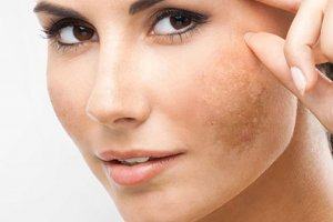Prevent Melasma With Daily Skin Care Habits Understanding