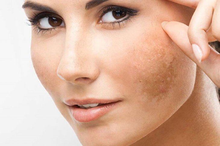 Ngăn Ngừa Nám Da Bằng Thói Quen Chăm Sóc Da Hằng Ngày