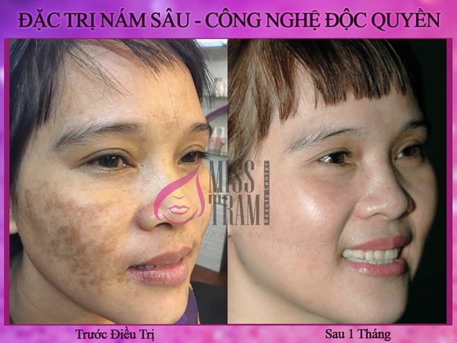 The Notes When Treating Melasma with Real Laser Technology