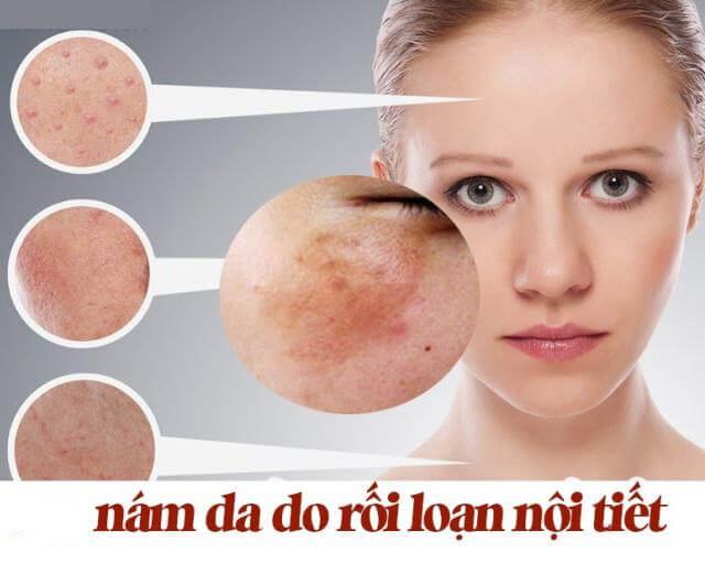 Nám da do rối loạn nội tiết tố