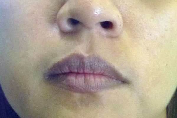 Causes of dark lips in men