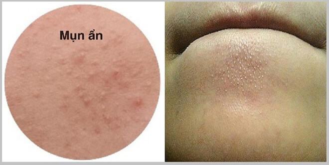 What is hidden acne?
