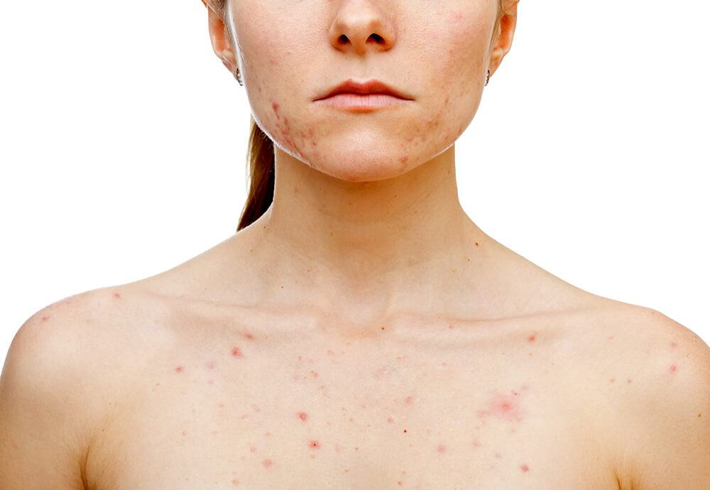 What is body acne?