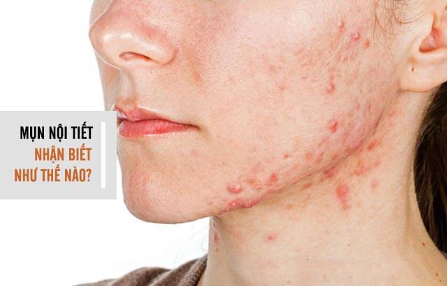 Hormonal disorders cause body acne