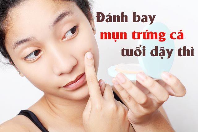 How to treat teenage acne?