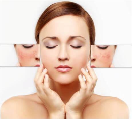 The Secret to Effective Melasma Care At Home Reflection