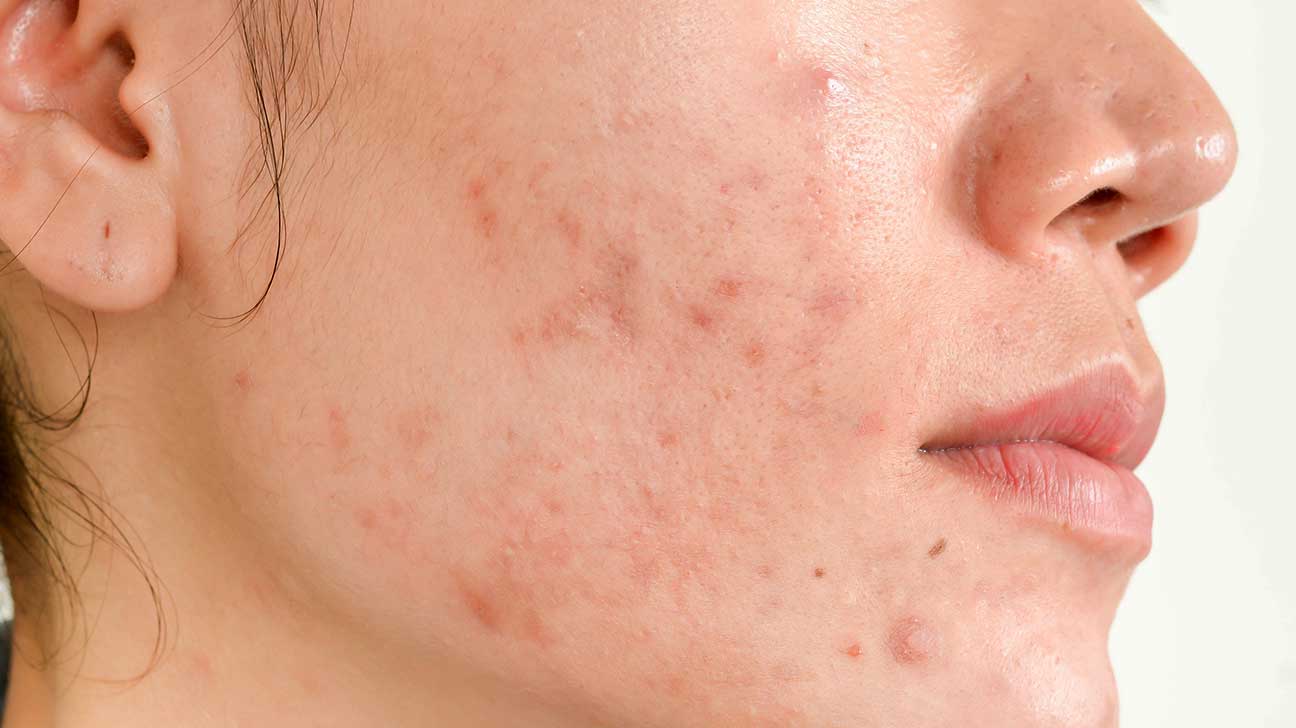 The secret to fly away acne scars and bruises