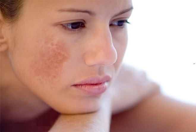 Reasons Why Middle Aged Women Appear Freckles Principle