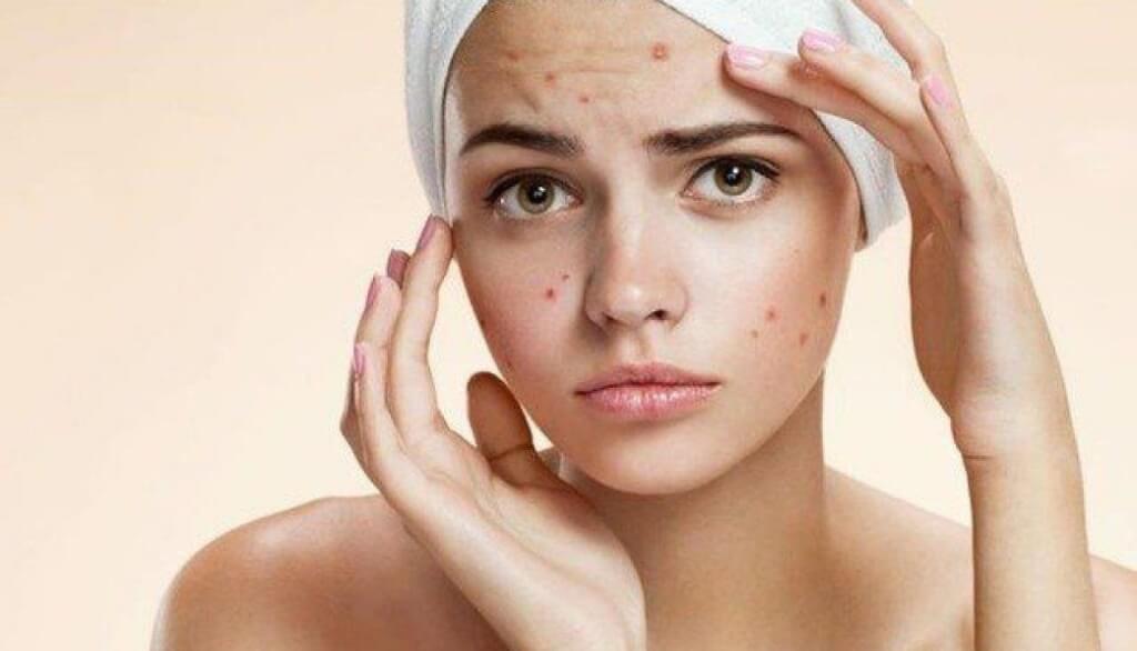 Top 6 Determinants of Acne Treatment Time to Catch