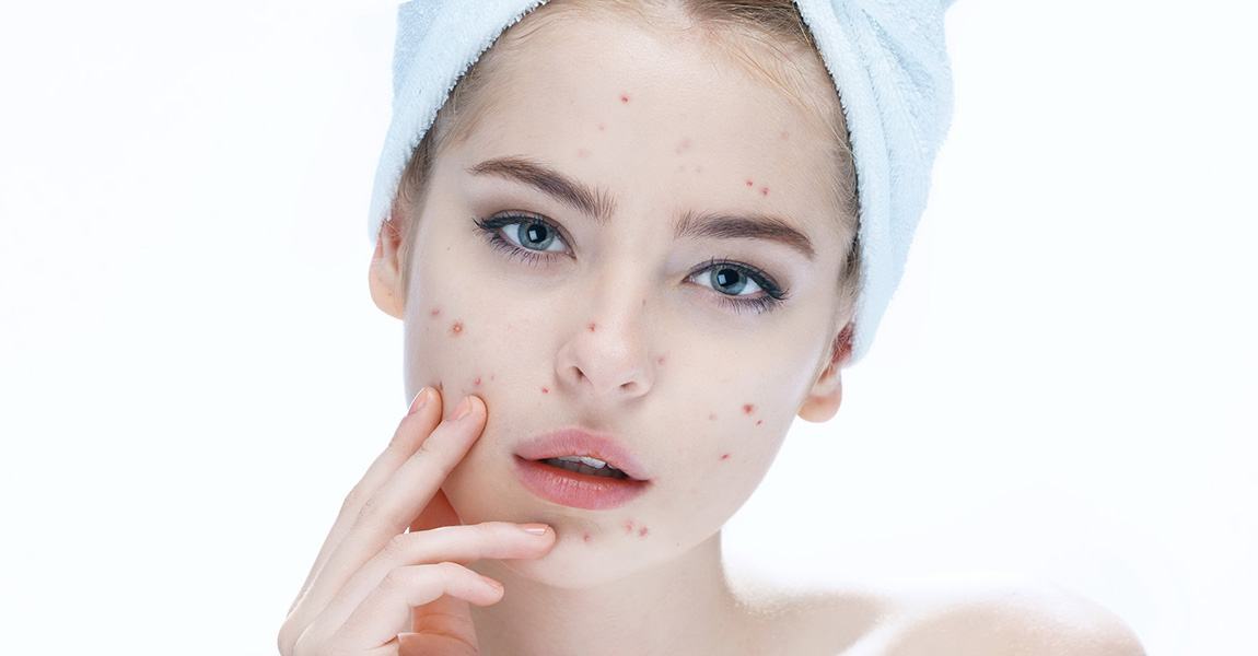 An Emergency Guide to Acne & Redness Due to Allergies Must See