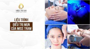 liệu trình điều trị mụn tại miss trâm