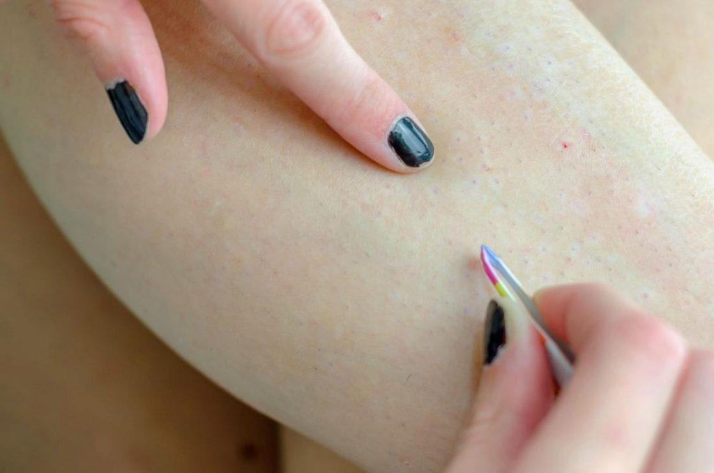 Simple and safe way to handle ingrown hairs at home