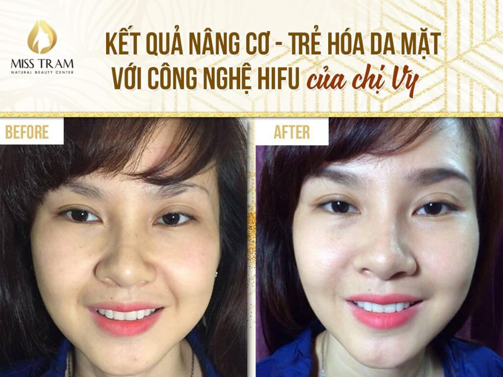 Results of lifting, facial rejuvenation with Hifu technology