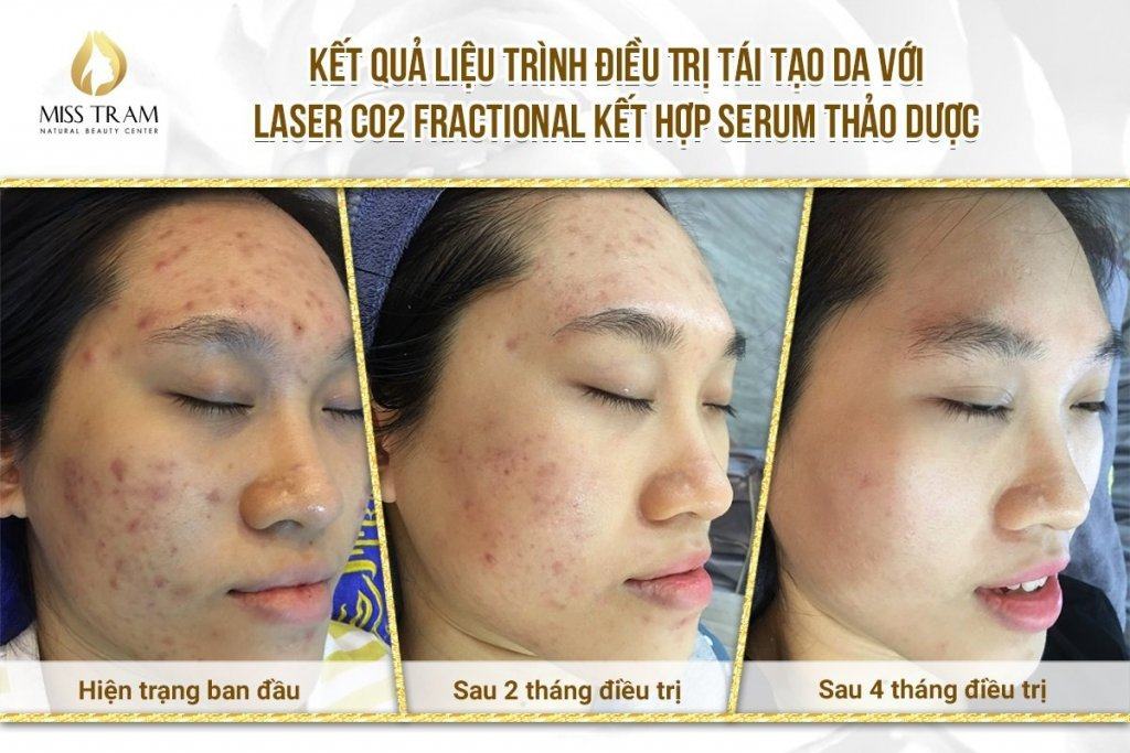 Result of Anh Thu Baby Skin Resurfacing Treatment With Co2 Fractional Laser With Herbal Serum