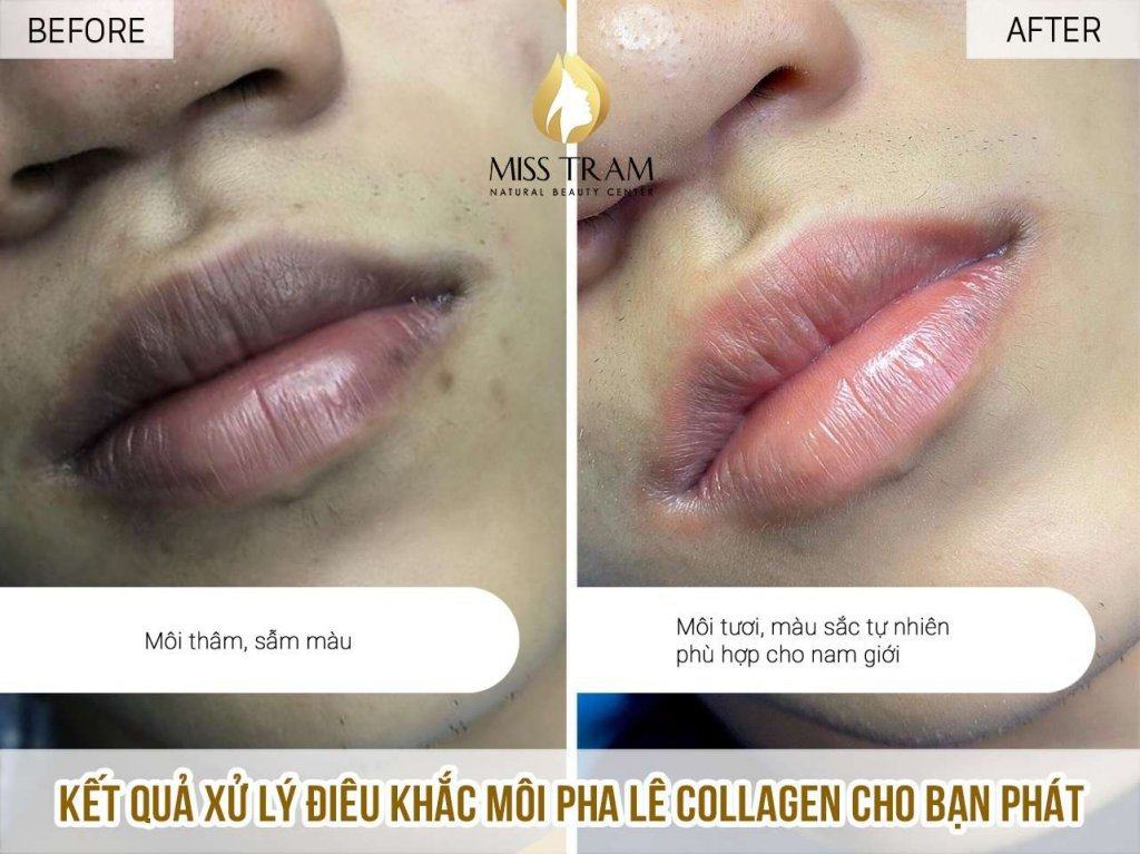 The Results Of Collagen Crystal Lip Sculpting Treatment For You