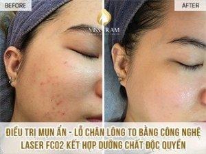 Điều Trị Mụn Ẩn, Lỗ Chân Lông To Bằng Laser CO2 Fractional Phổ biến