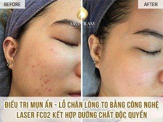 CO2 Fractional Laser Treatment for Hidden Acne and Large Pores Result