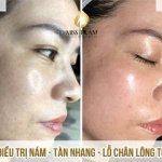 Treatment of Melasma - Freckles - Pores For Ms. Nguyet Research