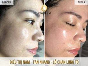 Điều Trị Nám - Tàn Nhang - Lỗ Chân Lông Cho Chị Nguyệt Mở mắt