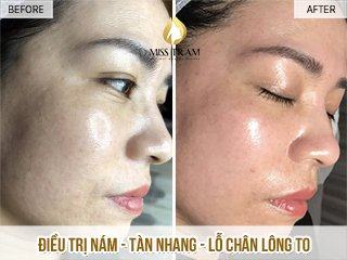 Treatment of Melasma - Freckles - Pores For Ms. Nguyet Detail