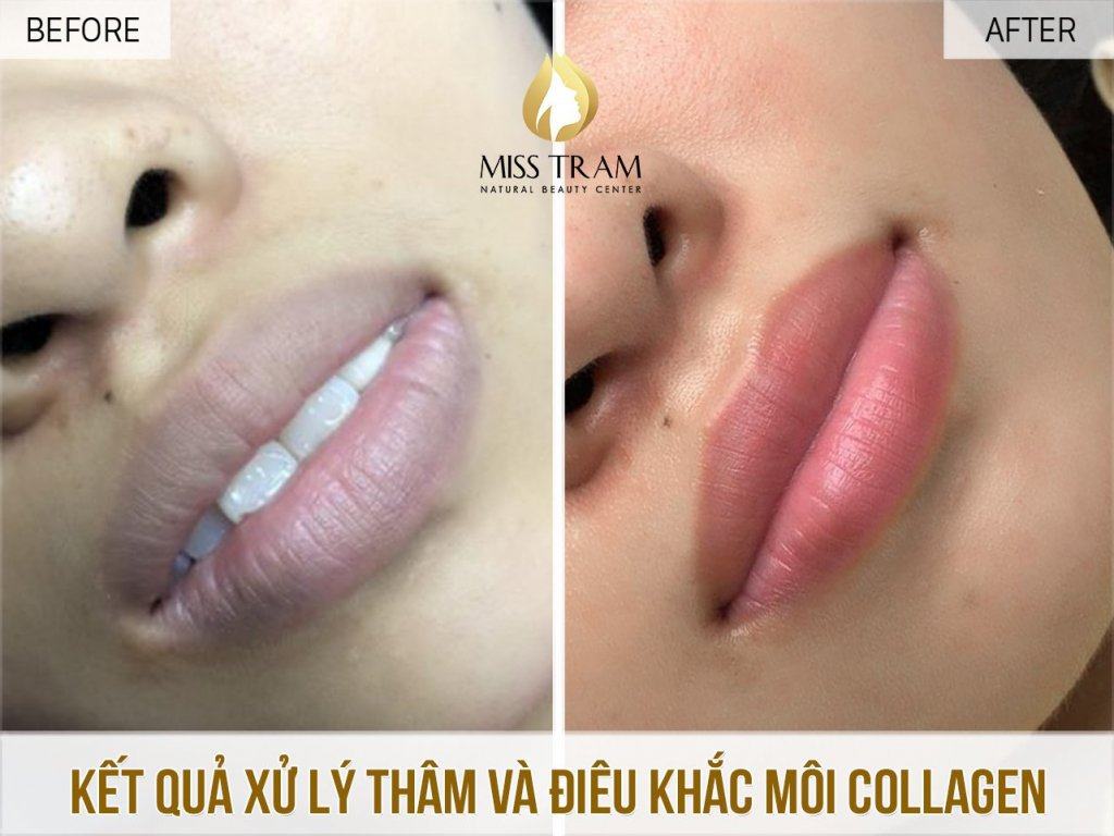 Dark Lip Treatment Results - Natural Peach Pink Collagen Lip Sculpting Emphasis