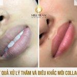 Kết Quả Xử Lý Môi Thâm Tái - Điêu Khắc Môi Collagen Màu Hồng Đào Tự Nhiên Nghiên cứu