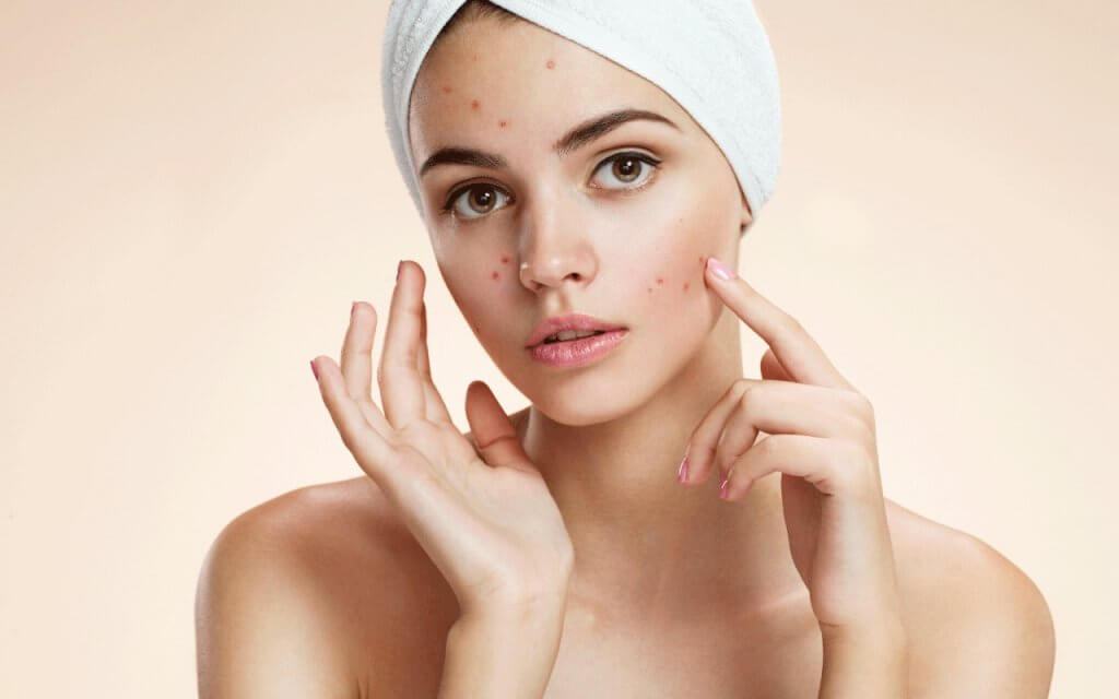 Guidelines for Skin Care with Hormonal Acne Correctly Principles