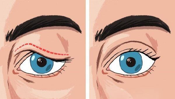 Mí mắt bị sụp nguyên nhân do đâu? Cách điều trị mí mắt bị sụp hiệu quả nhất?