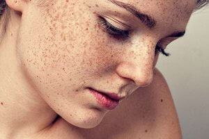 The Secret To Fading Freckles With Coconut Oil Super Simple Full