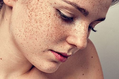The Secret To Fading Freckles With Coconut Oil Super Simple Package