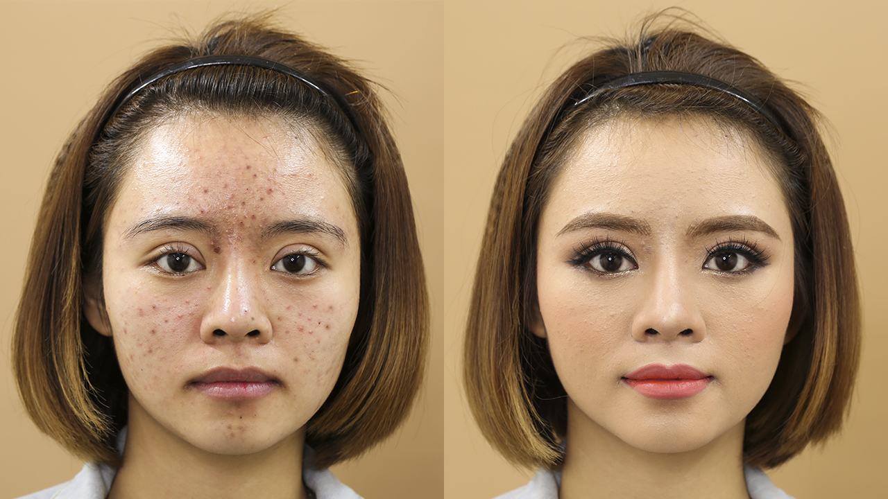 Makeup Notes For Acne Skin Blog