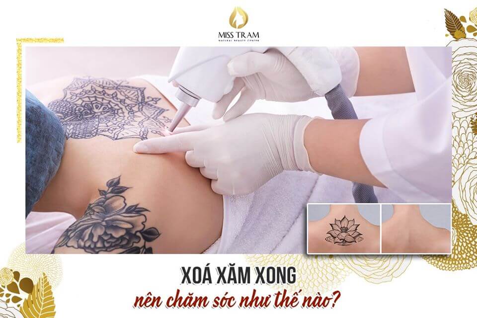How To Take Care Of After Tattoo Removal Discover