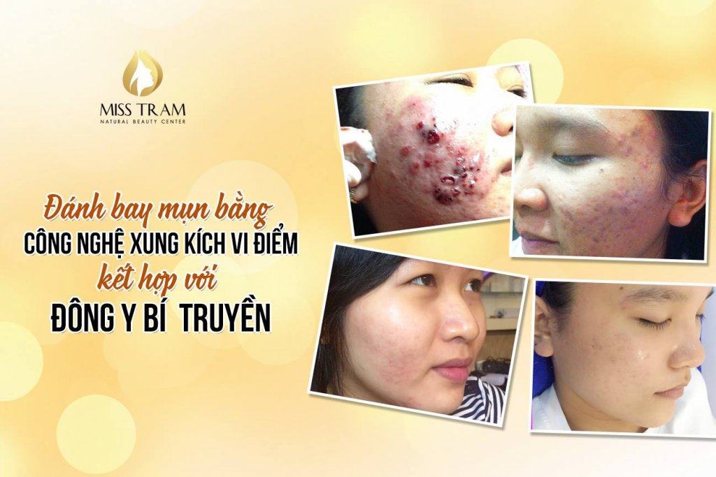 Acne Treatment With MICROPRACTIVE TECHNOLOGY combined with SECRETS Oriental Medicine Results