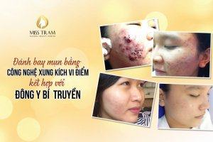 Treating Acne With MICROPRUCTION TECHNOLOGY combined with SECRETS Oriental Medicine Delight