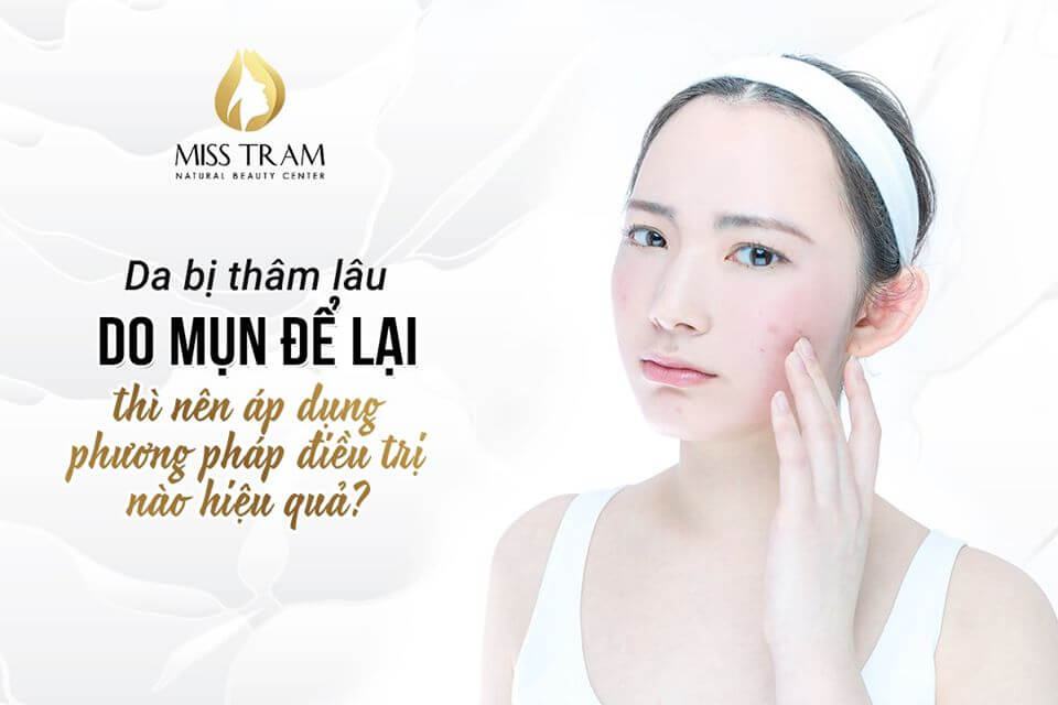 Phương Pháp Trị Da Thâm Do Mụn Hiệu Quả Nhất Hiện Nay