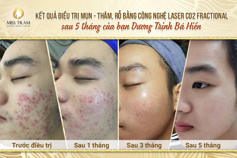 liệu trình điều trị mụn an toàn