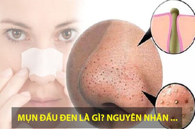  Nguyên nhân gây nên mụn đầu đen