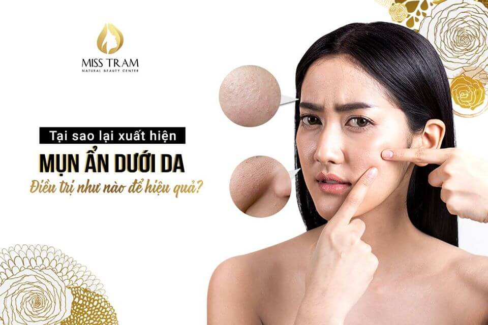 Tại Sao Lại Xuất Hiện Mụn Ẩn Dưới Da Và Cách Điều Trị Hiệu Quả Thú vị