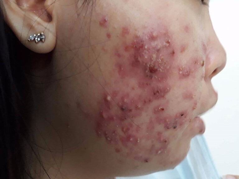 The Unpredictable Consequences When Squeezing Acne The Wrong Way
