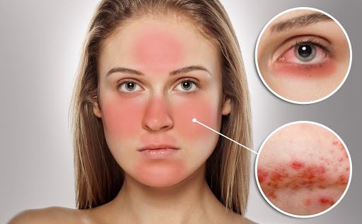 Symptoms of sensitive skin